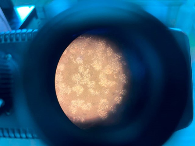 Identifican marcadores tempranos para atender cáncer de hígado y cirrosis